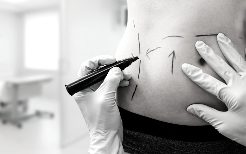 A doctor puts surgical marks on a patient's stomach with a marker. 