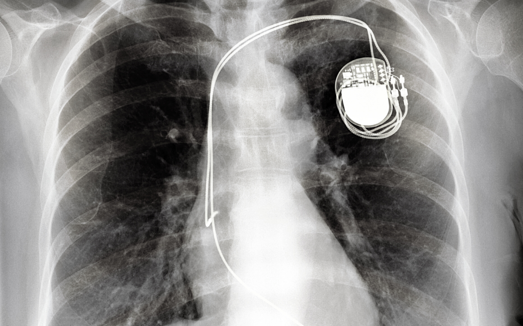 X-ray of chest with a pacemaker. 