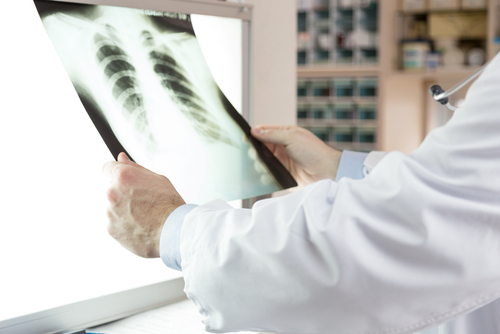 Doctor wearing lab coat looking at an x-ray of patient's ribs.