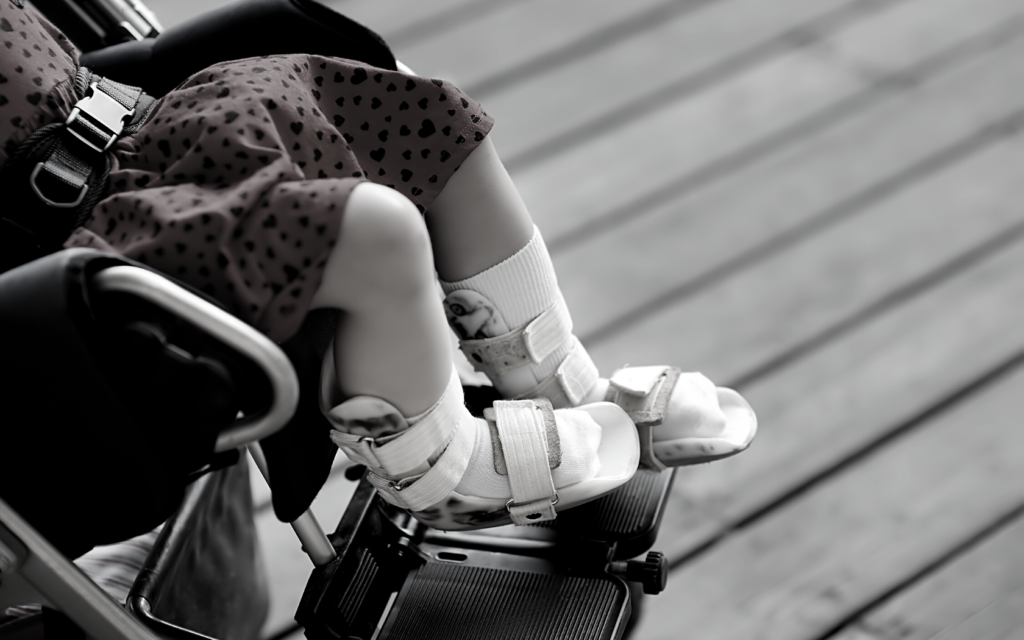 Little girl with cerebral palsy sits in wheelchair. 