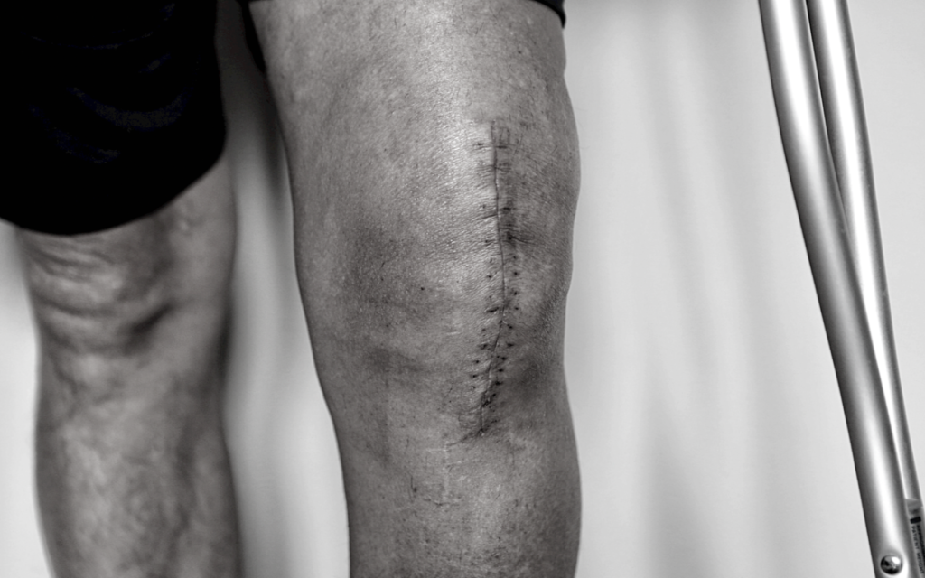 A bad knee replacement surgery can lead to both physical and mental scars.
