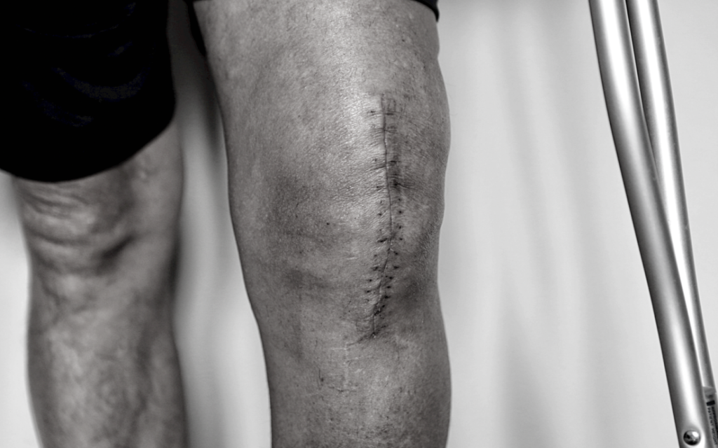A bad knee replacement surgery can lead to both physical and mental scars.