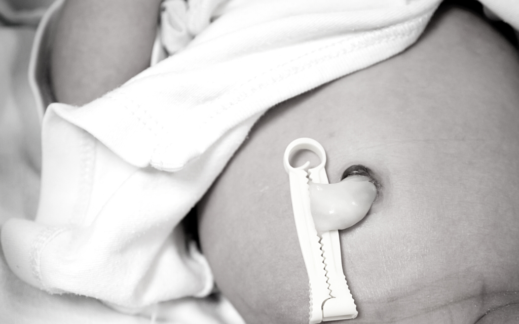 Baby's umbilical cord stump.