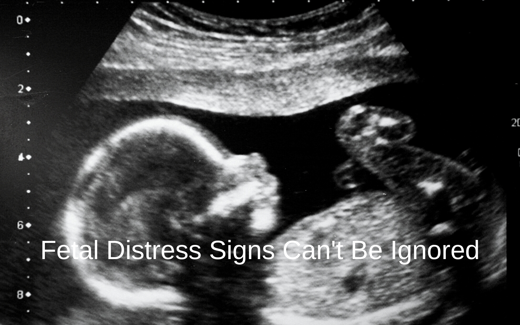 An ultrasound can show fetal distress signs, if present.