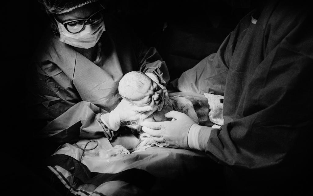 Baby delivered via emergency C-section.
