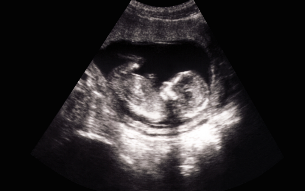Ultrasound of baby in womb.