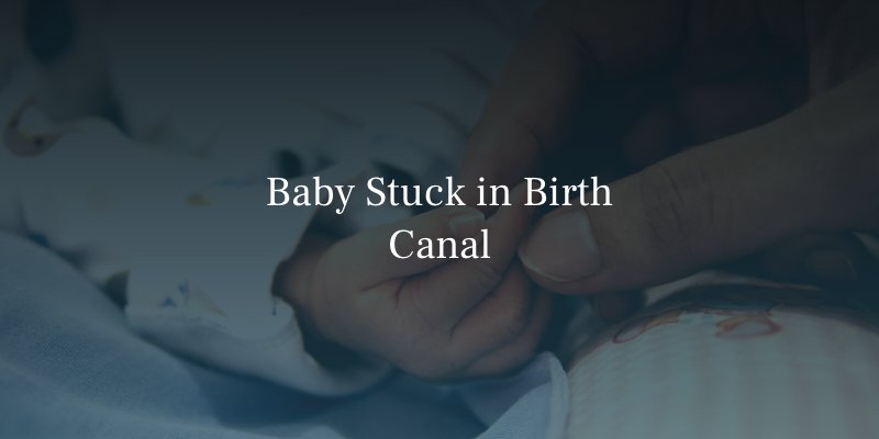 Baby Stuck in Birth Canal