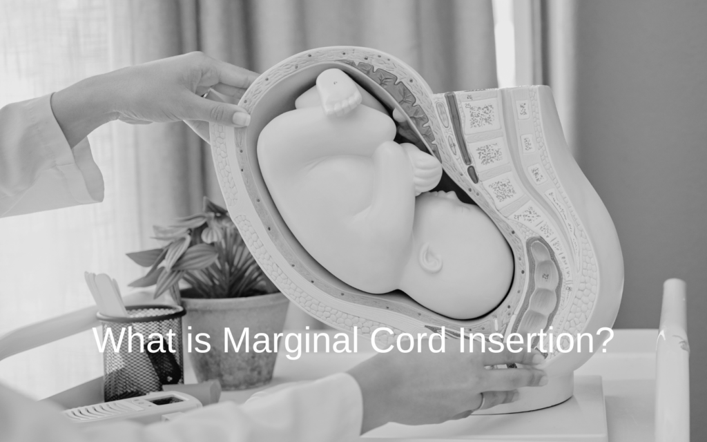 Marginal Cord Insertion Risks and Complications